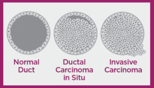 illustration of normal duct, dcis, and invasive carcinoma