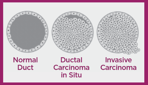 illustration of normal duct, dcis, and invasive carcinoma